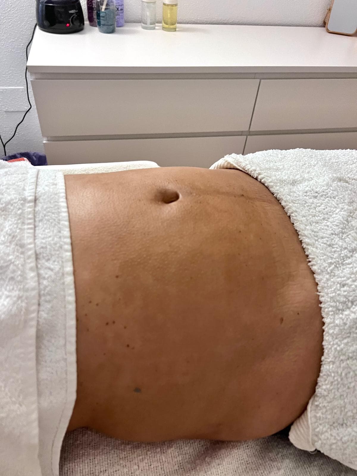 Drenagem Linfática — Antes