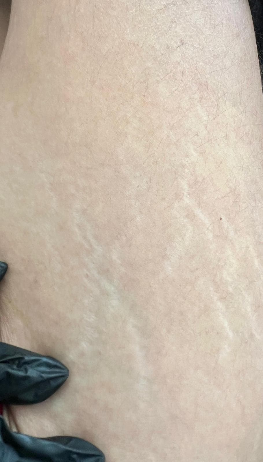 Tratamento de Estrias — Antes